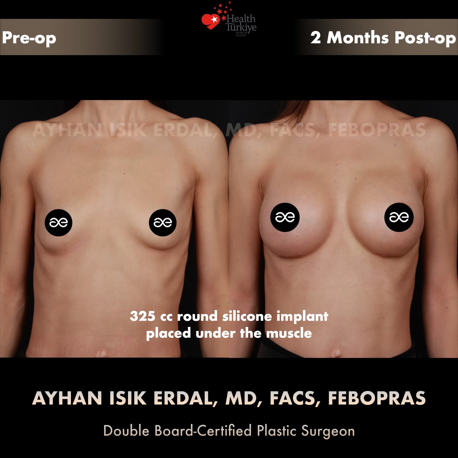 Breast augmentation before and after — 325cc implant, frontal view, 2 months post-op
