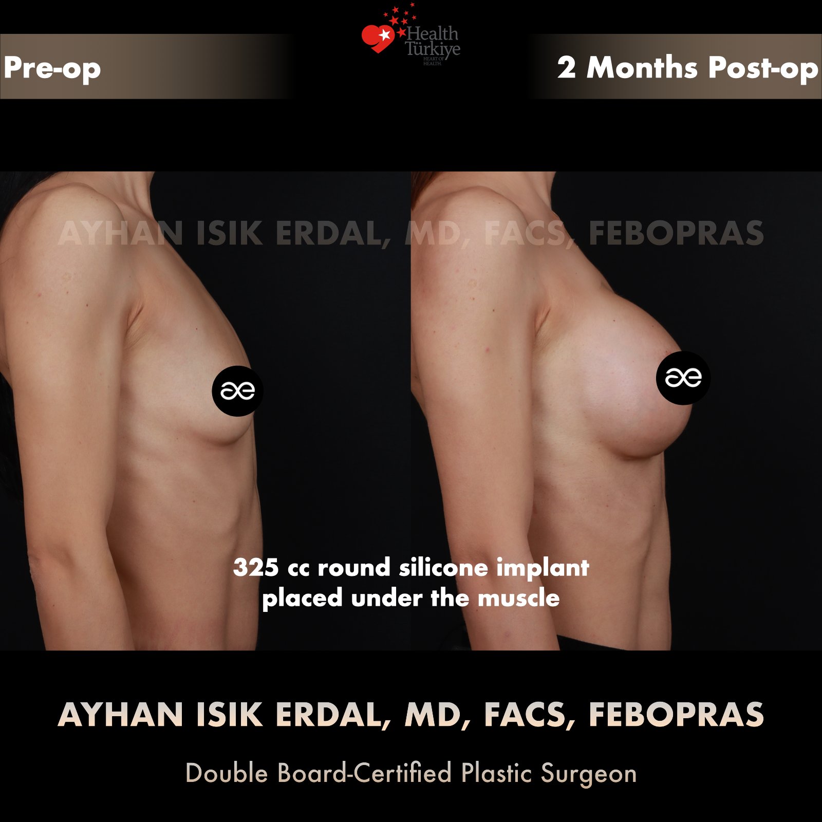 Breast augmentation — 325 cc · Under Muscle, lateral view, 2 Months Post-op