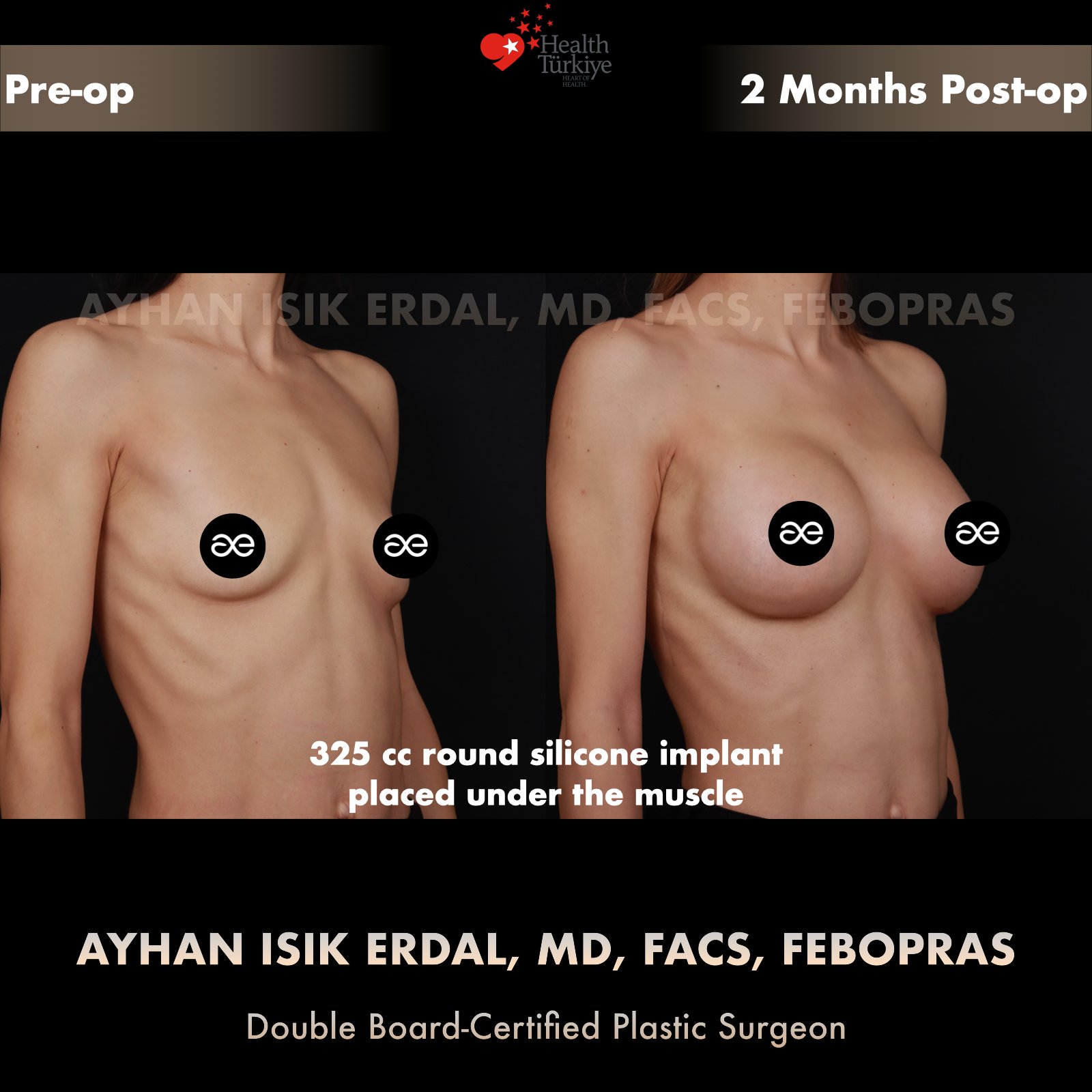 Breast augmentation — 325 cc · Under Muscle, oblique view, 2 Months Post-op