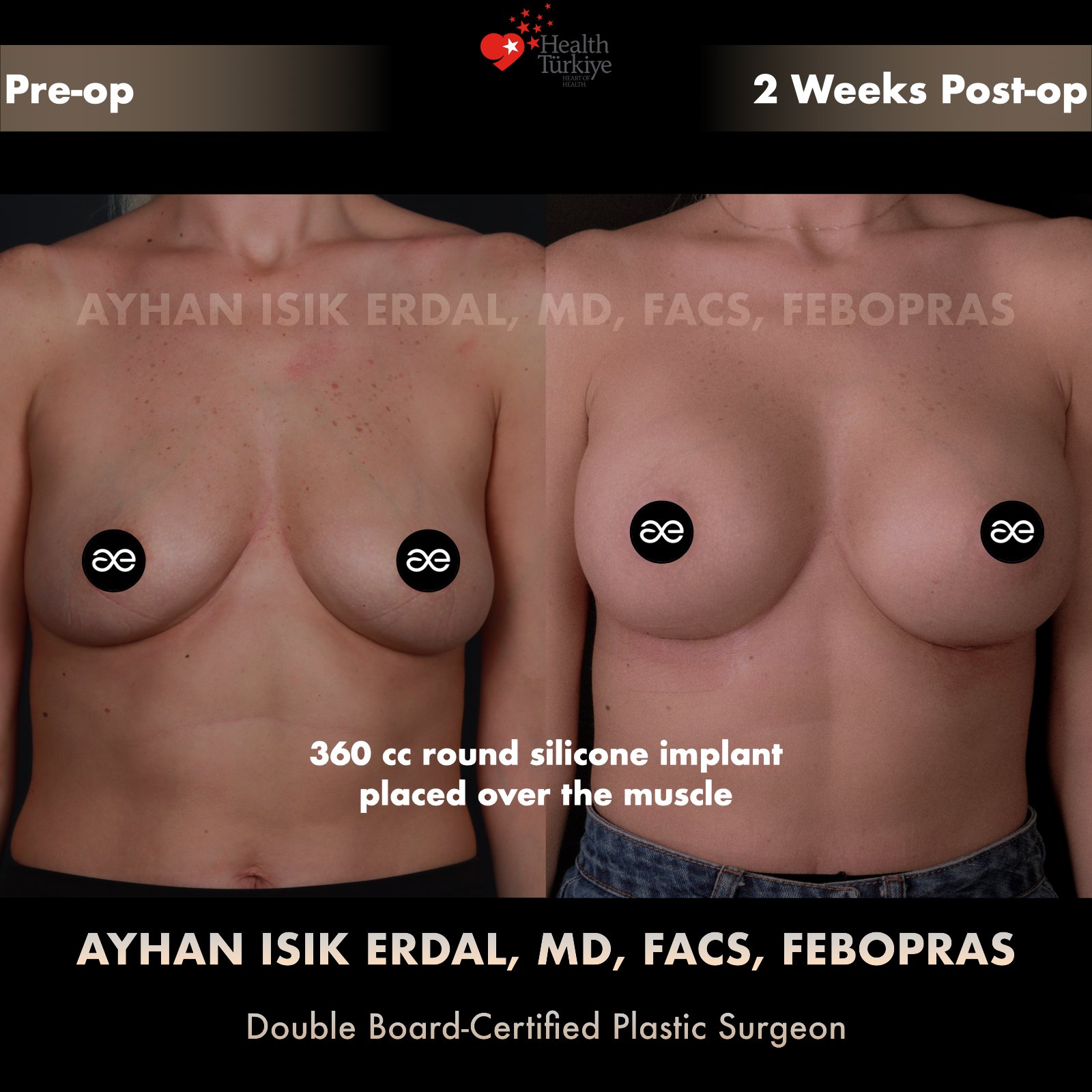 Breast augmentation before and after — 360cc round silicone implant, frontal view, 2 weeks post-op