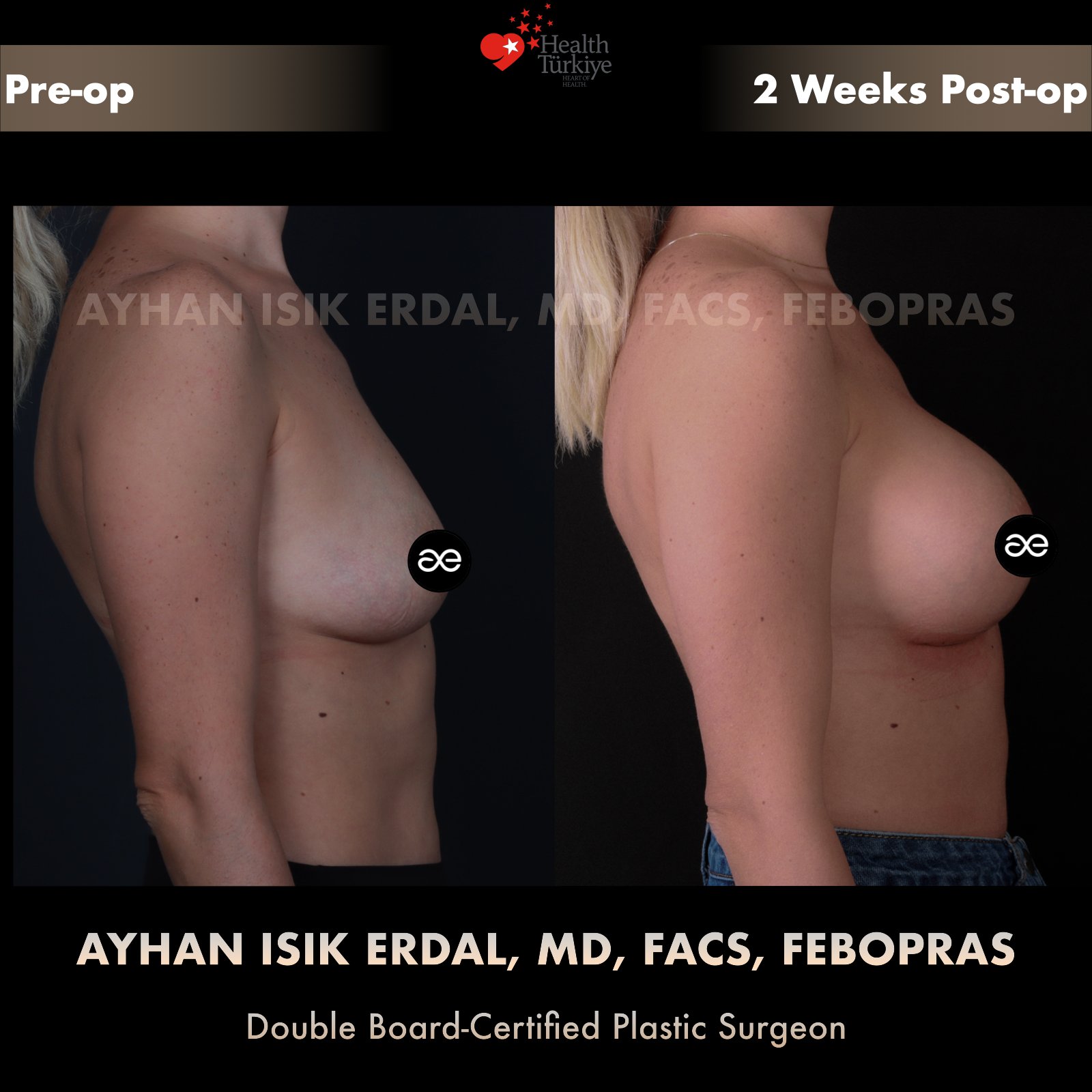 Breast augmentation — 360 cc · Over Muscle, lateral view, 2 Weeks Post-op