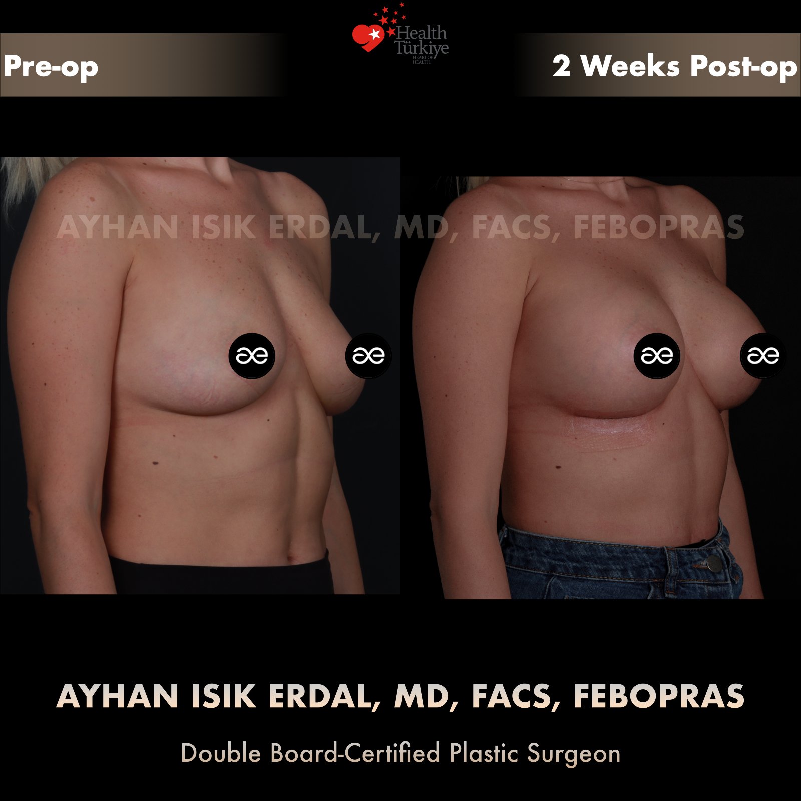 Breast augmentation — 360 cc · Over Muscle, oblique view, 2 Weeks Post-op