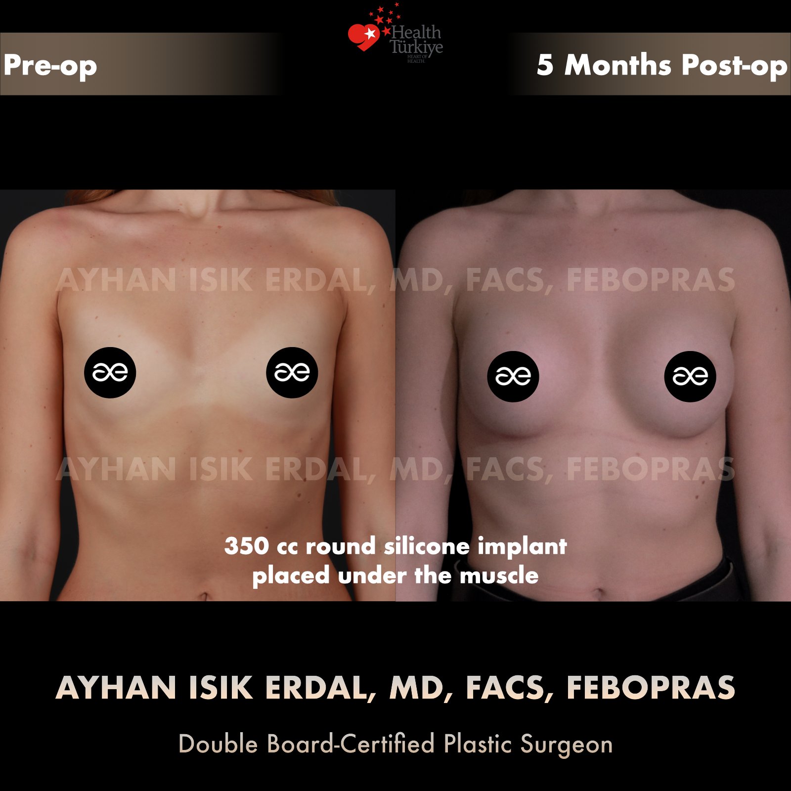 Breast augmentation before and after — 350cc implant, frontal view, 5 months post-op