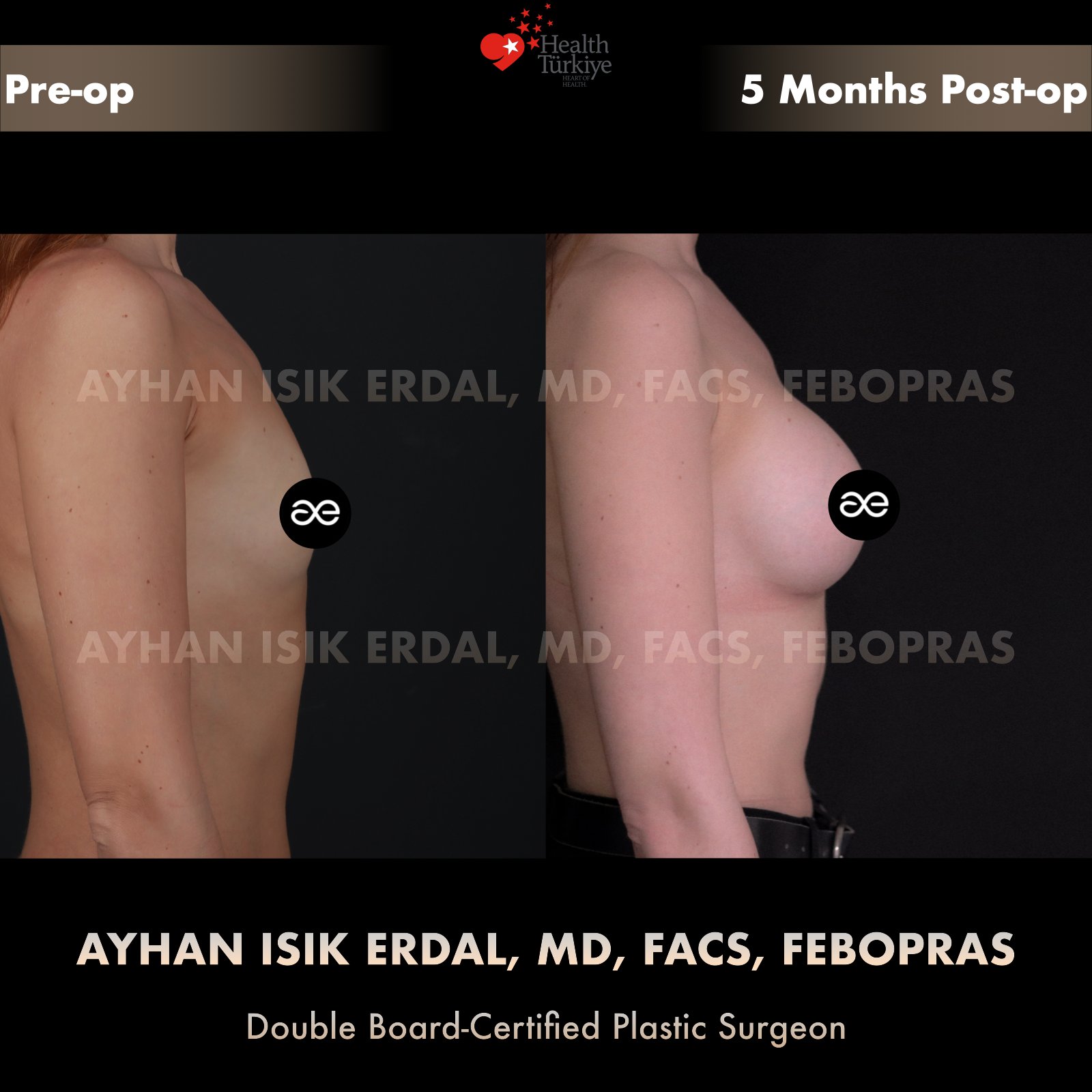 Breast augmentation — 350 cc · Under Muscle, lateral view, 5 Months Post-op