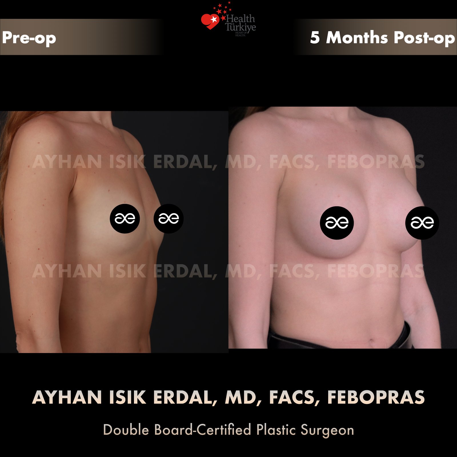 Breast augmentation — 350 cc · Under Muscle, oblique view, 5 Months Post-op