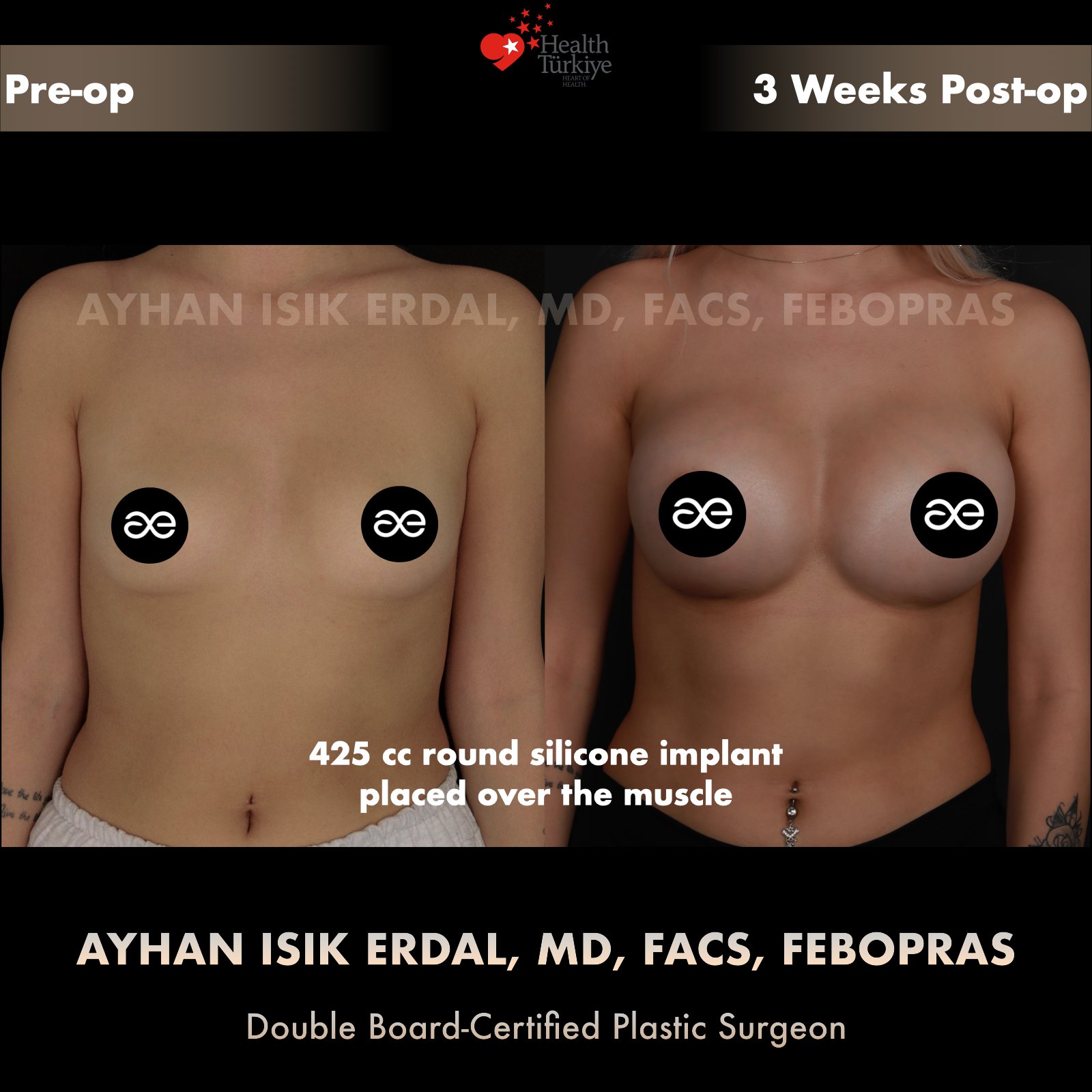 Breast augmentation before and after — 425cc implant, frontal view, 3 weeks post-op