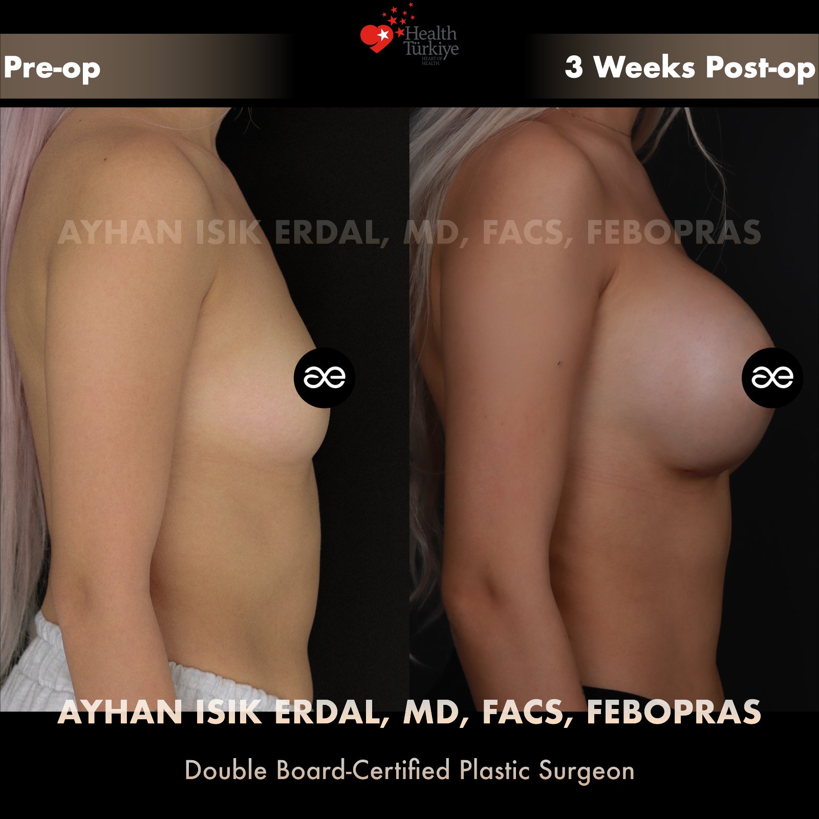 Breast augmentation — 425 cc · Over Muscle, lateral view, 3 Weeks Post-op