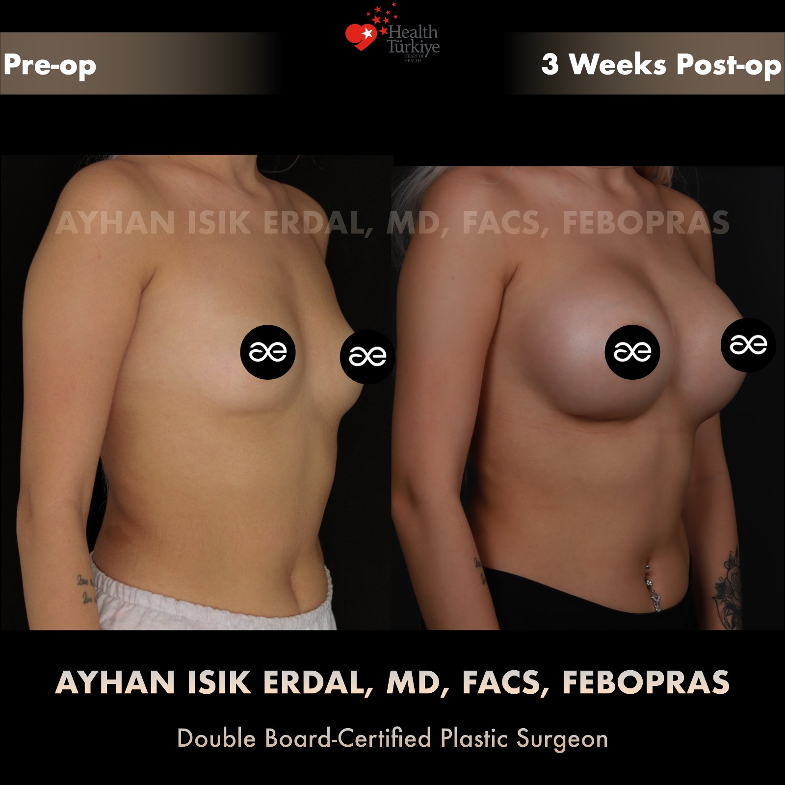 Breast augmentation — 425 cc · Over Muscle, oblique view, 3 Weeks Post-op
