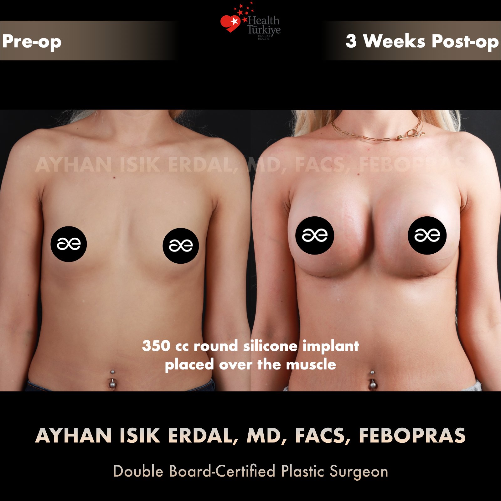 Breast augmentation before and after — 350cc implant, frontal view, 3 weeks post-op