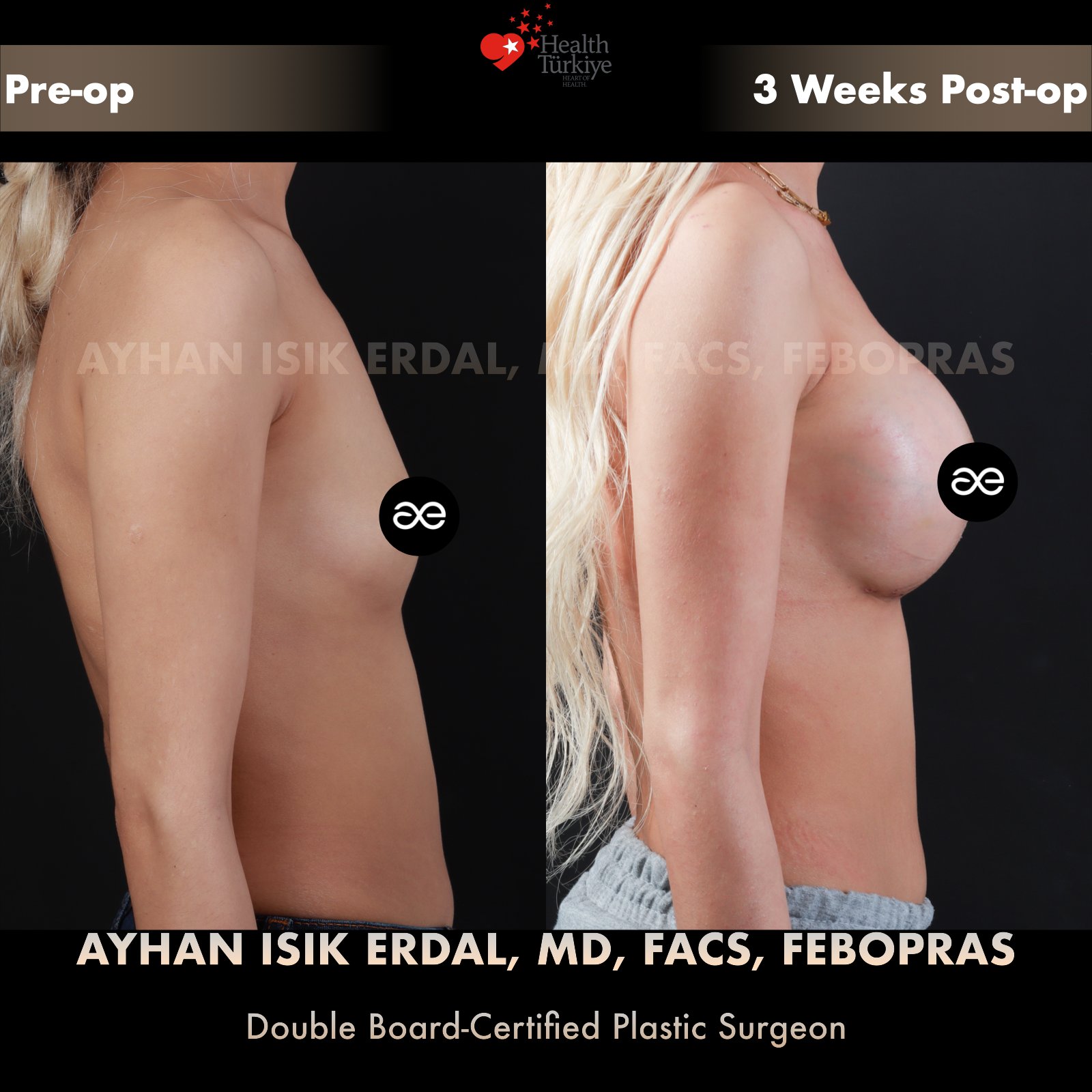 Breast augmentation — 350 cc · Over Muscle, lateral view, 3 Weeks Post-op