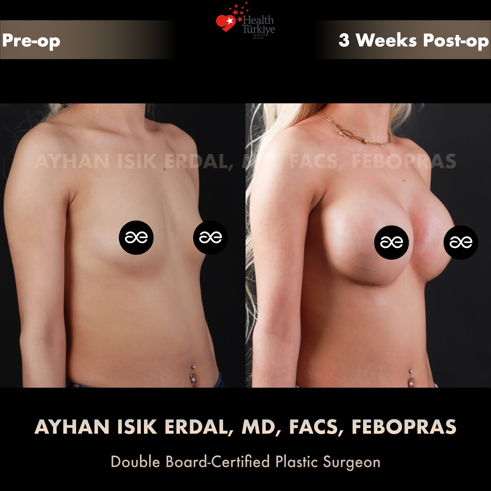 Breast augmentation — 350 cc · Over Muscle, oblique view, 3 Weeks Post-op