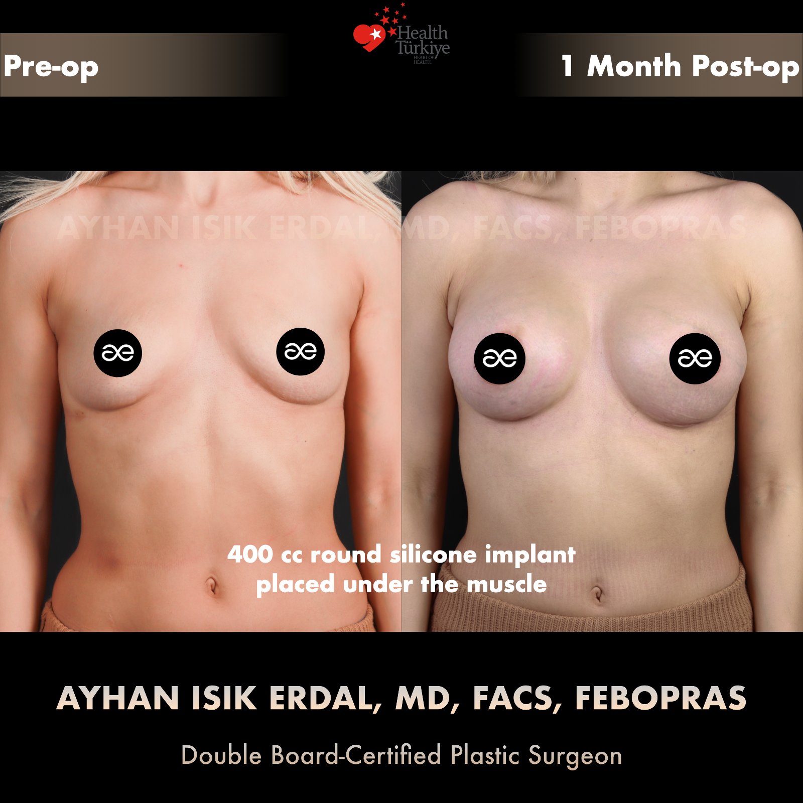 Breast augmentation before and after — 400cc implant, frontal view, 1 month post-op