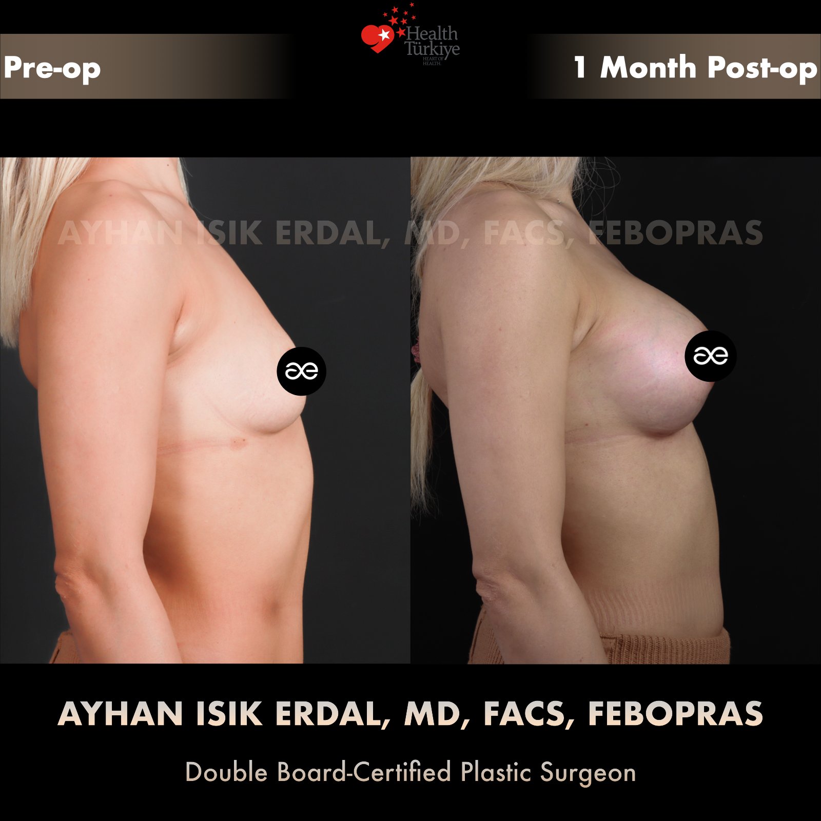 Breast augmentation — 400 cc · Under Muscle, lateral view, 1 Month Post-op
