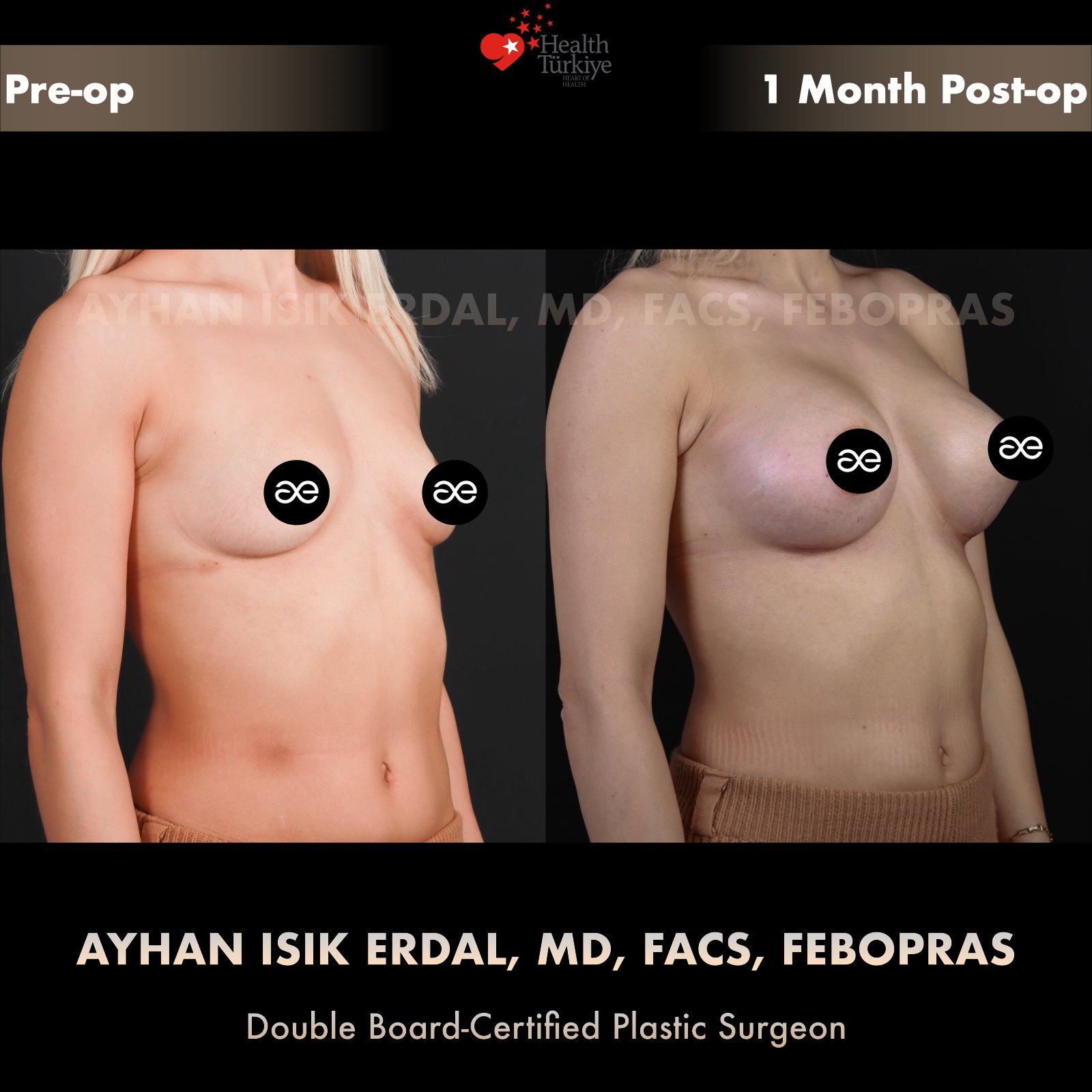 Breast augmentation — 400 cc · Under Muscle, oblique view, 1 Month Post-op