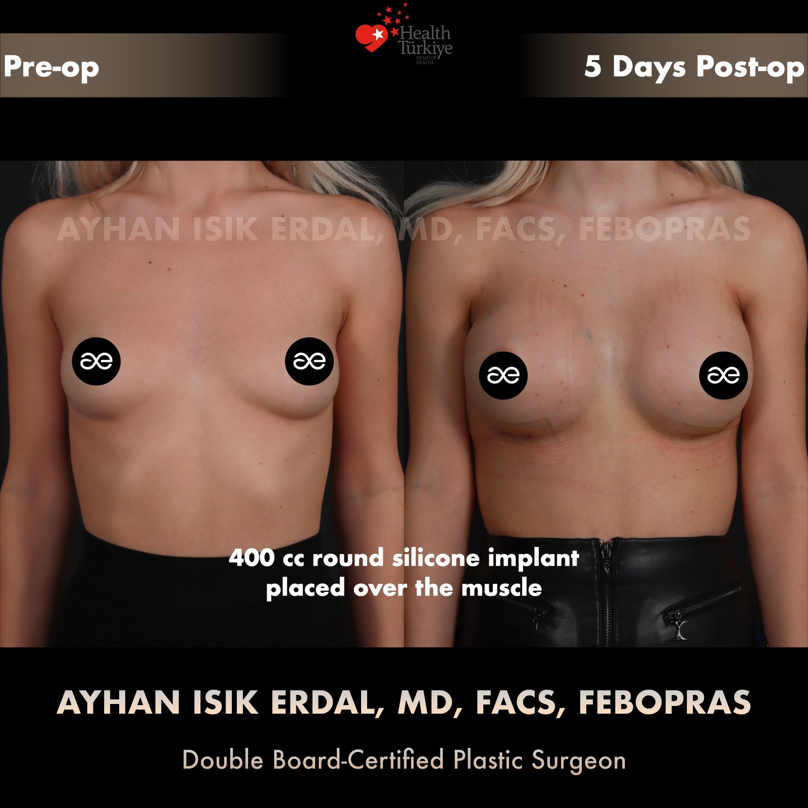 Breast augmentation before and after — 400cc implant, frontal view, 5 days post-op