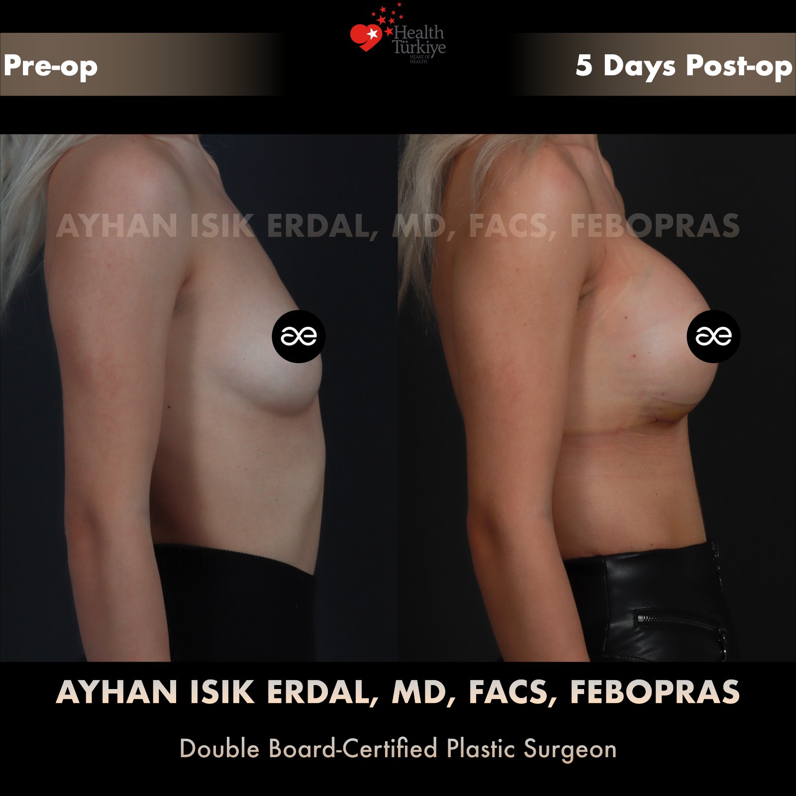Breast augmentation — 400 cc · Over Muscle, lateral view, 5 Days Post-op