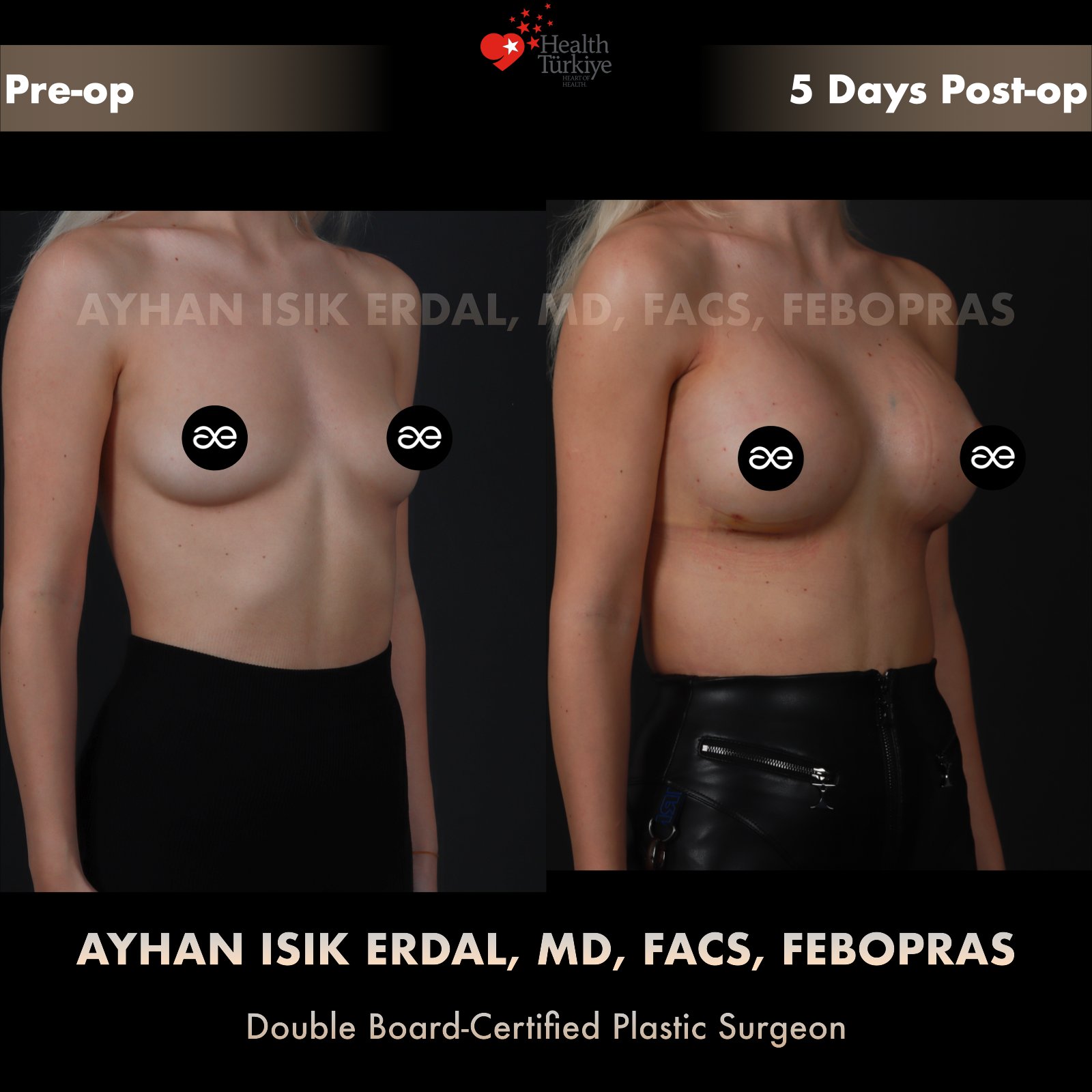 Breast augmentation — 400 cc · Over Muscle, oblique view, 5 Days Post-op
