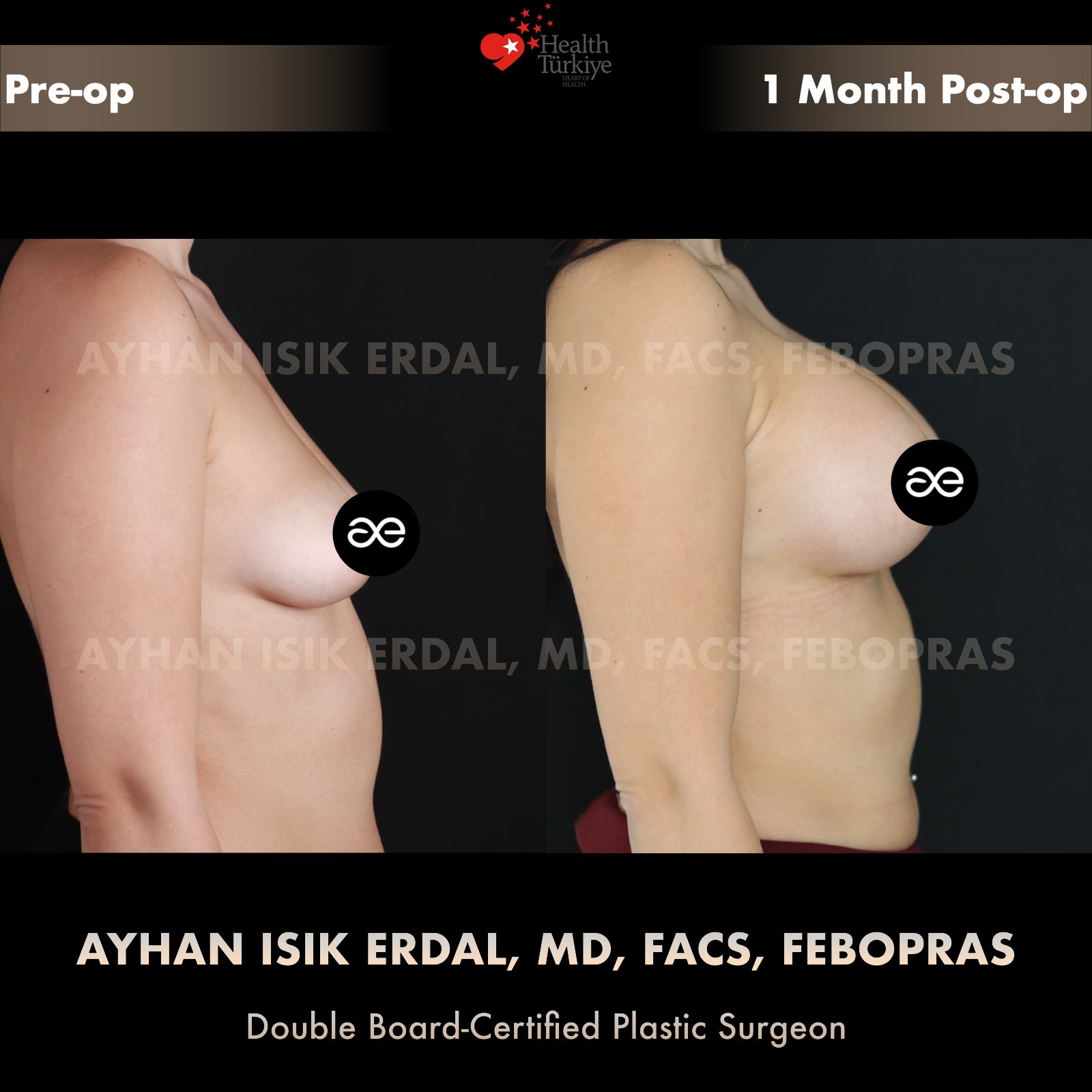 Breast augmentation — 350 cc · Over Muscle, lateral view, 1 Month Post-op