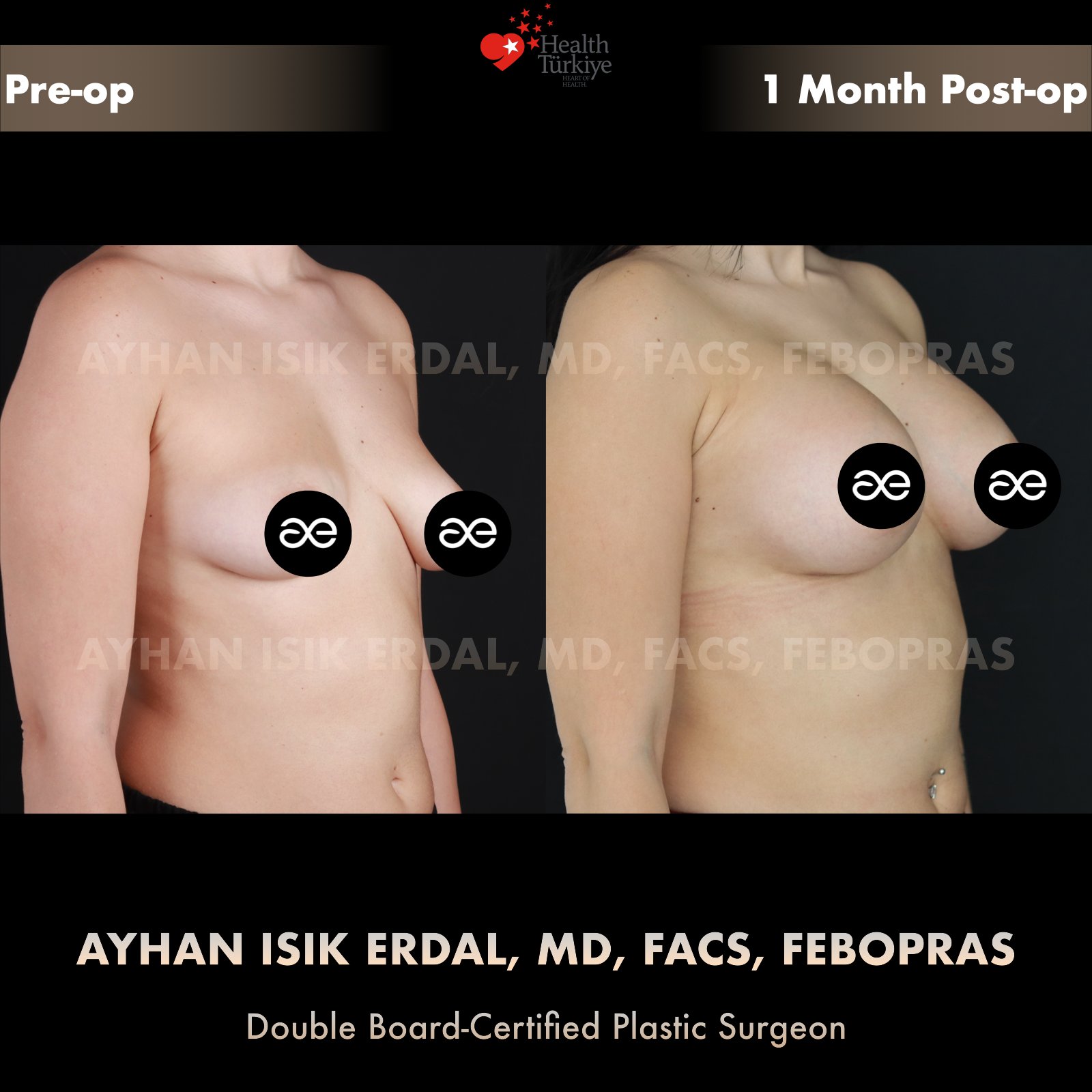 Breast augmentation — 350 cc · Over Muscle, oblique view, 1 Month Post-op