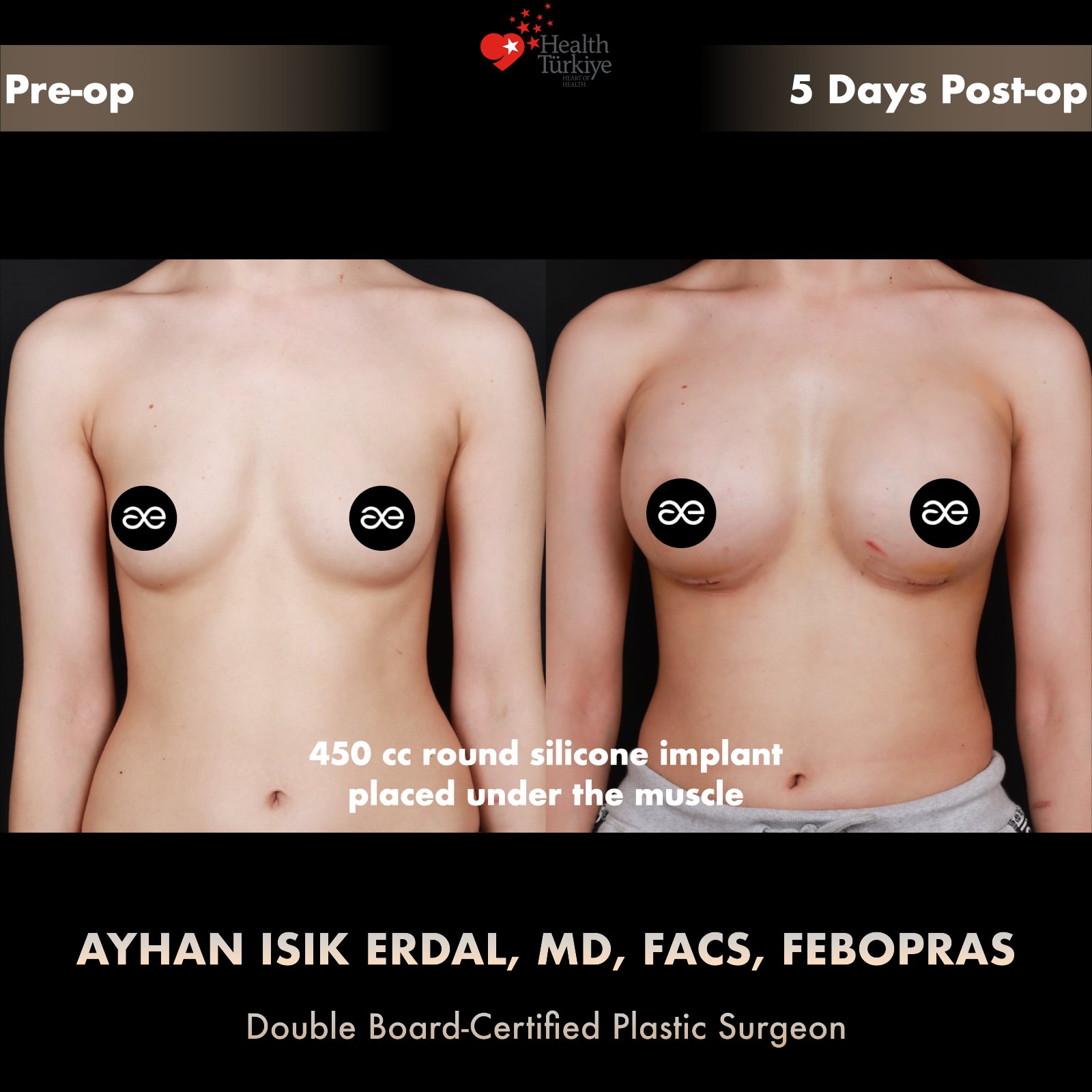 Breast augmentation before and after — 450cc implant, frontal view, 5 days post-op