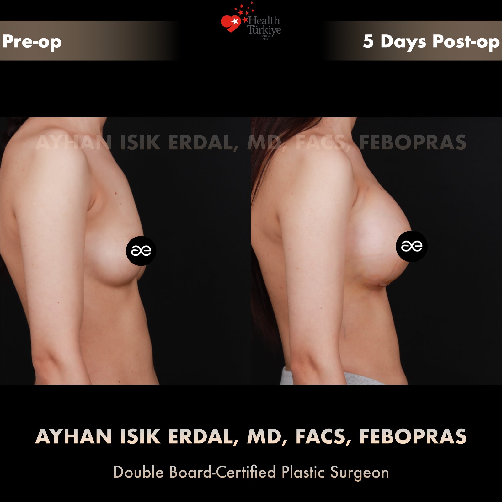 Breast augmentation — 450 cc · Under Muscle, lateral view, 5 Days Post-op