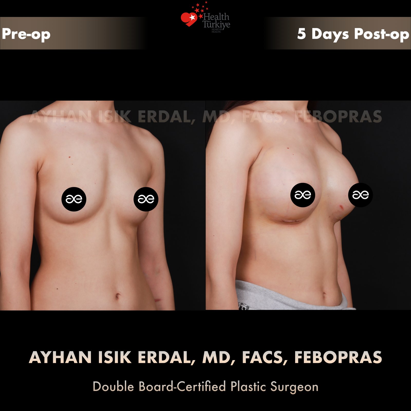 Breast augmentation — 450 cc · Under Muscle, oblique view, 5 Days Post-op