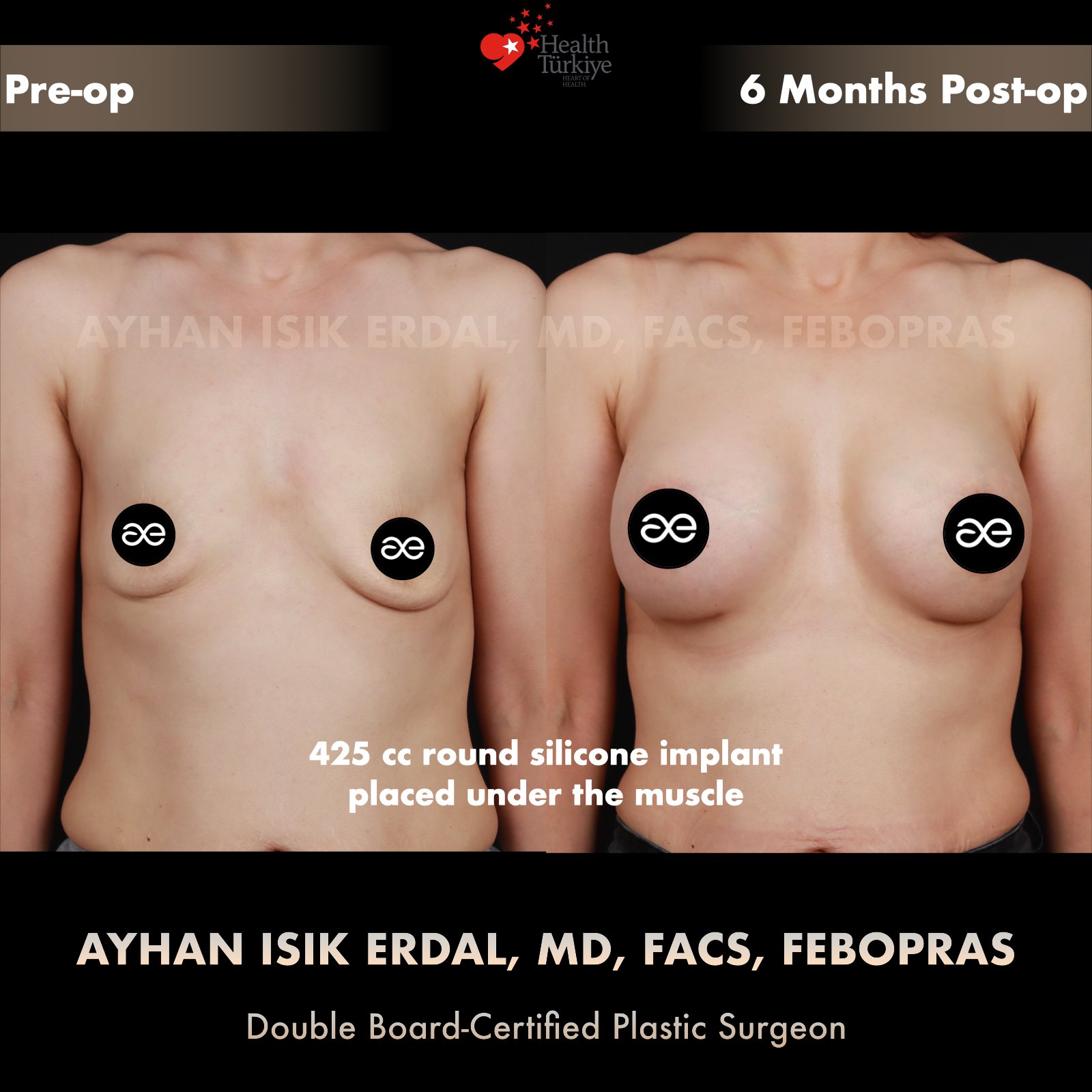 Breast augmentation before and after — 425cc implant, frontal view, 6 months post-op