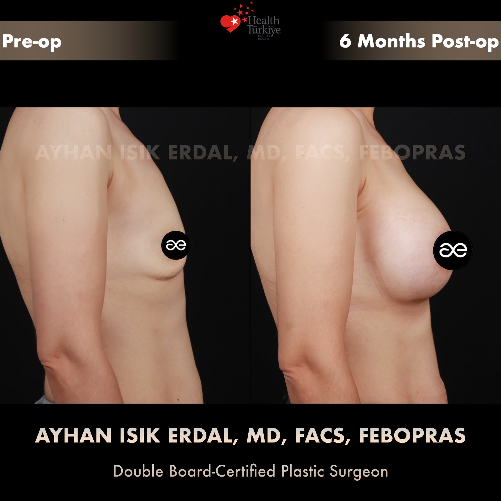 Breast augmentation — 425 cc · Under Muscle, lateral view, 6 Months Post-op