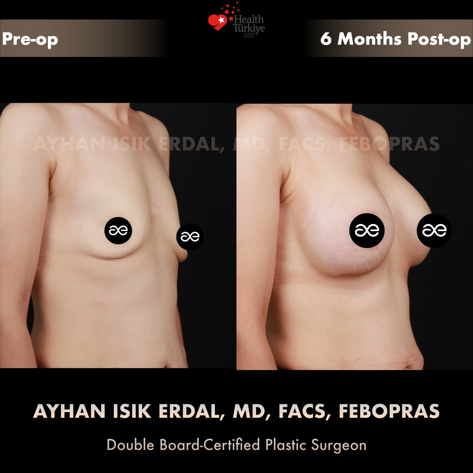 Breast augmentation — 425 cc · Under Muscle, oblique view, 6 Months Post-op